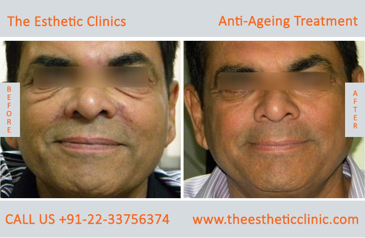 Anti Aging Treatment for Face Wrinkles before after photos in mumbai india (1 (10)
